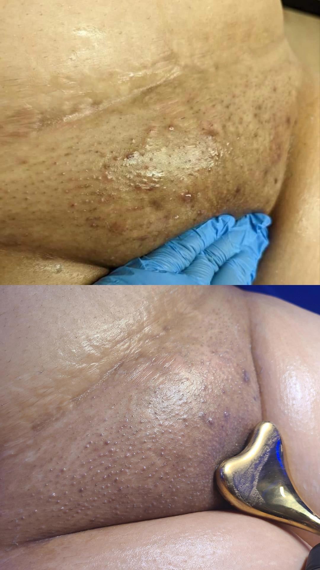 Ingrown Eliminator Duo Original